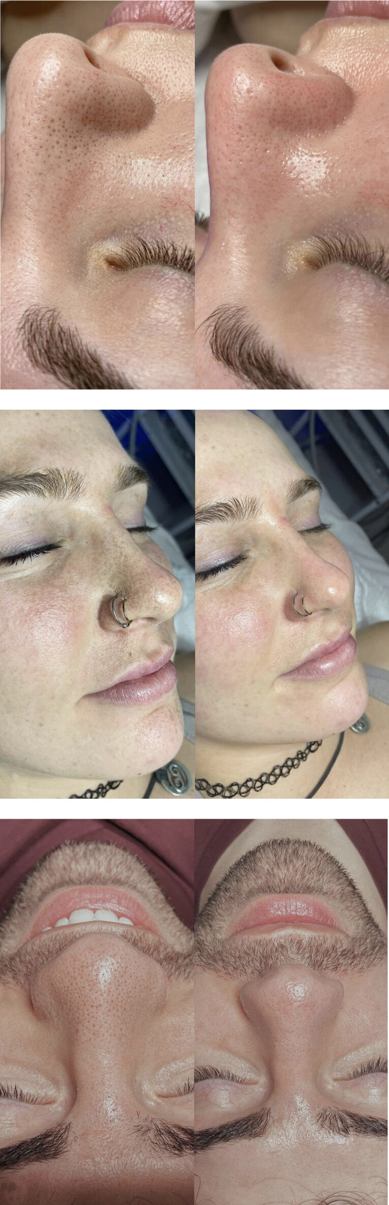 Hydrafacial Valencia CA before after results