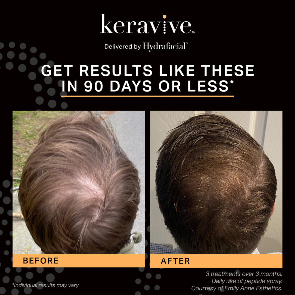 Keravive results